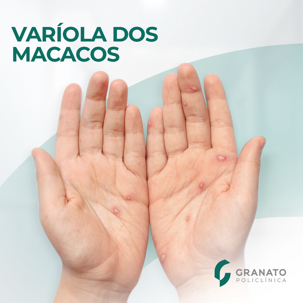 Varíola dos Macacos: tudo o que você precisa saber sobre a doença